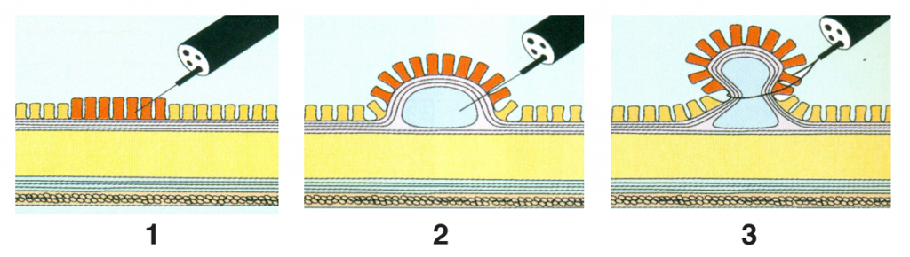 Tecnica del lifting